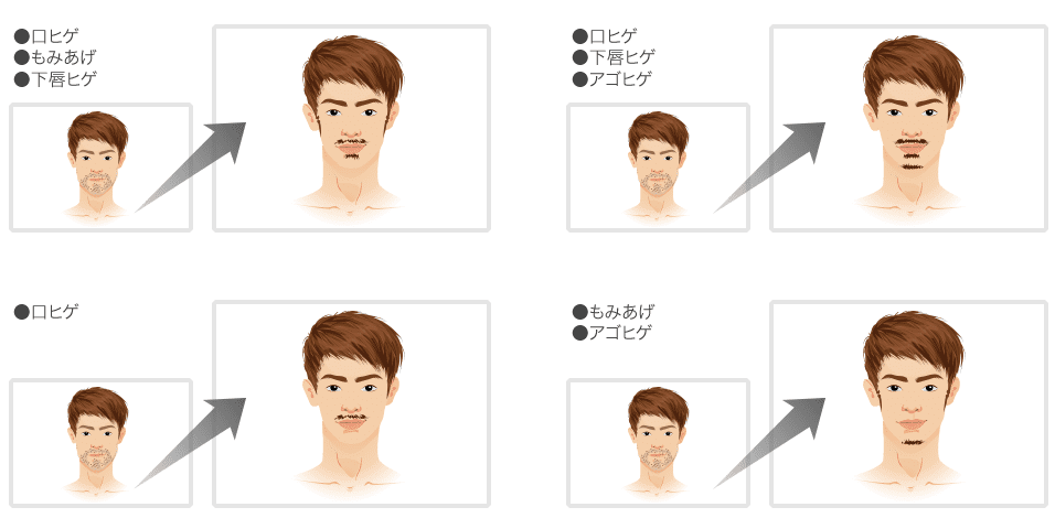 メンズキレイモ ヒゲデザイン
