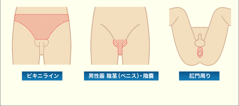 メンズリゼ陰部脱毛