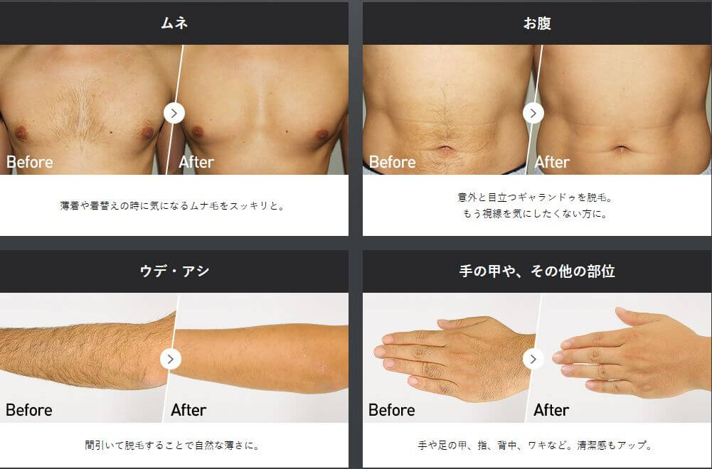 メンズTBCの脱毛前後比較
