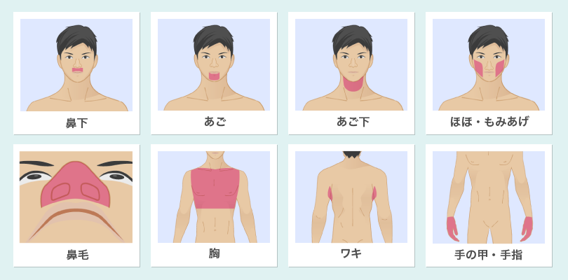 メンズリゼお試し脱毛