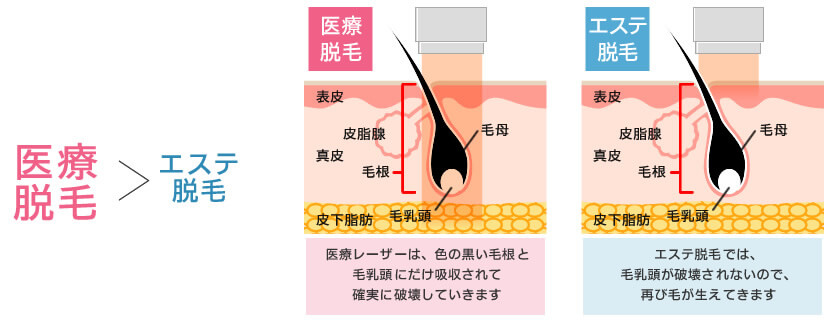 湘南美容クリニックメンズ脱毛