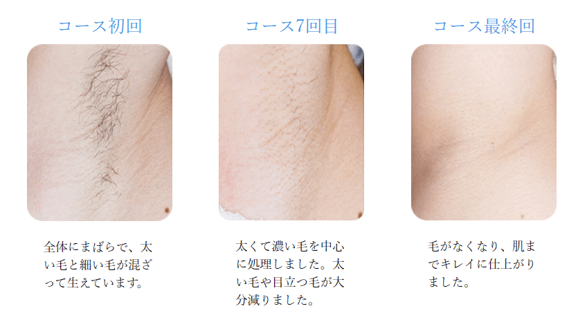 TBC　スーパー脱毛